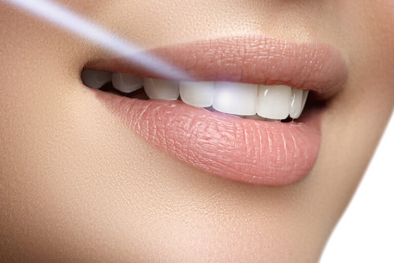 Fațete Ceramice Emax - Dental France