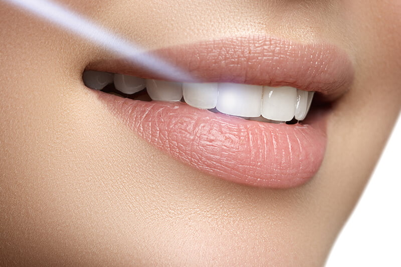 Fațete Ceramice Emax - Dental France